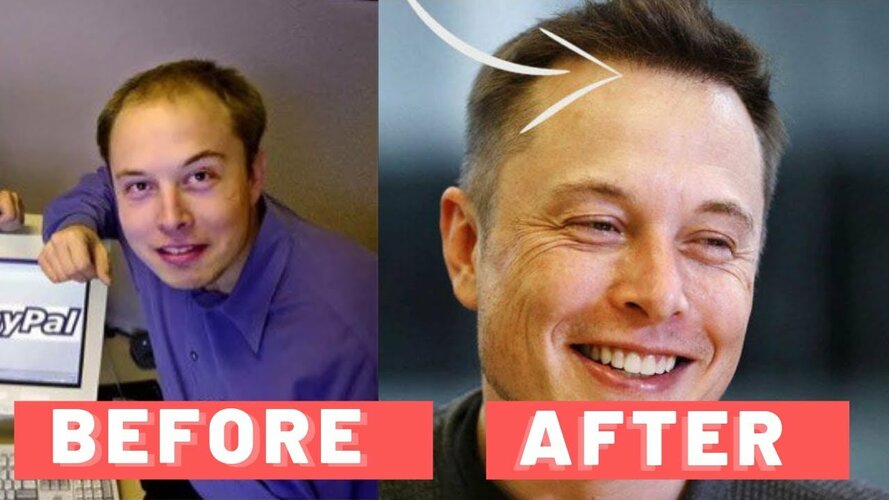 Hairtransplant.jpg